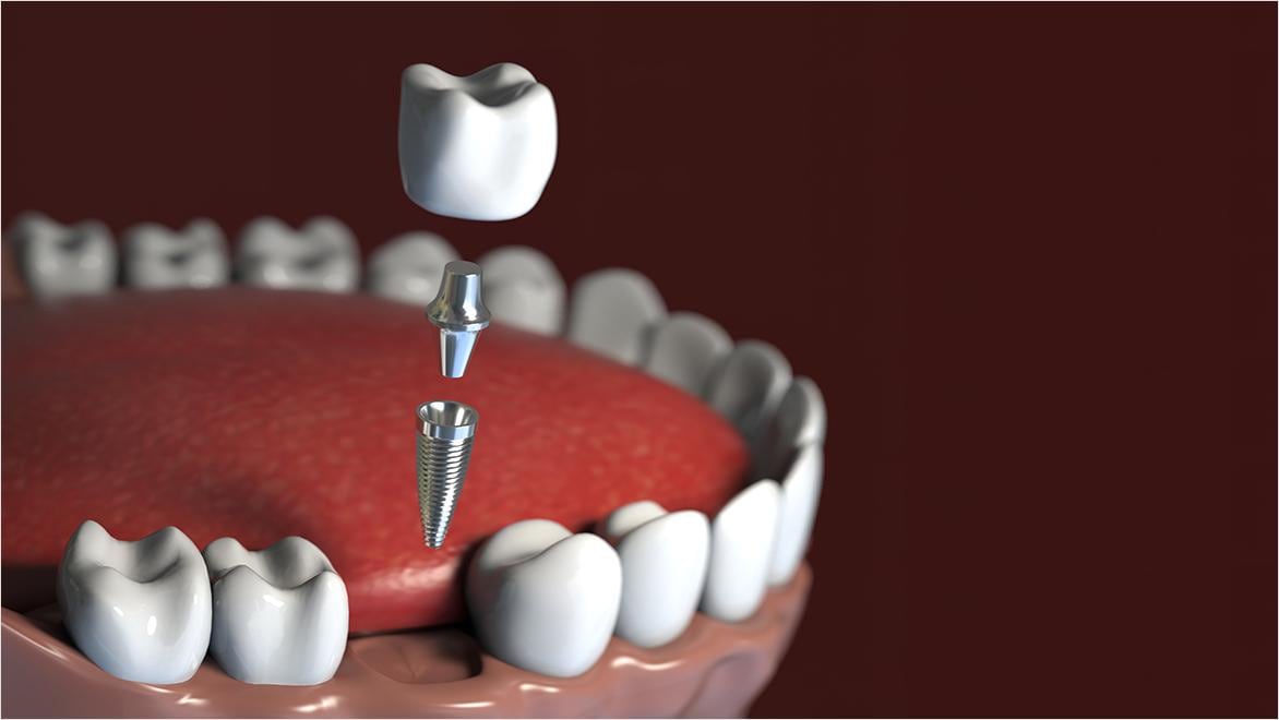 A computer rendering of a tooth, screw, and jaw showing the components of a dental implant.